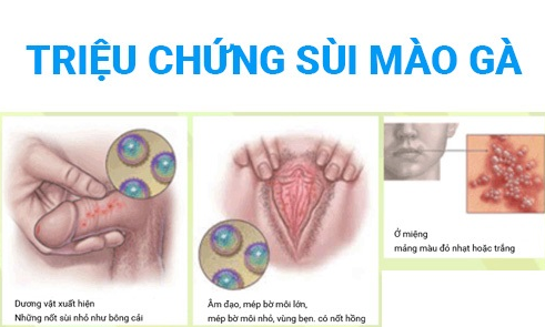 Triệu chứng sùi mào gà