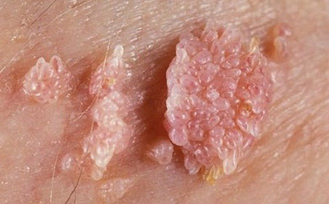 Triệu chứng bệnh sùi mào gà ở nam giới