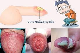Triệu chứng sưng bao quy đầu