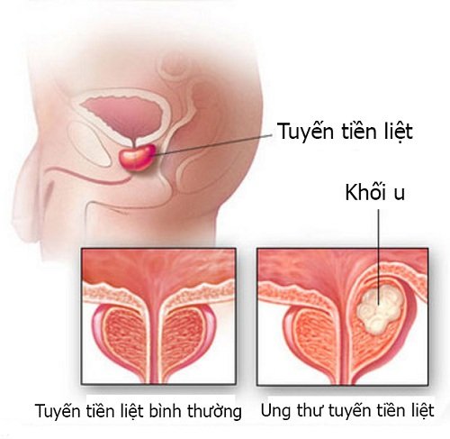 U xơ tiền liệt tuyến