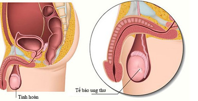 Bệnh ung thư tinh hoàn