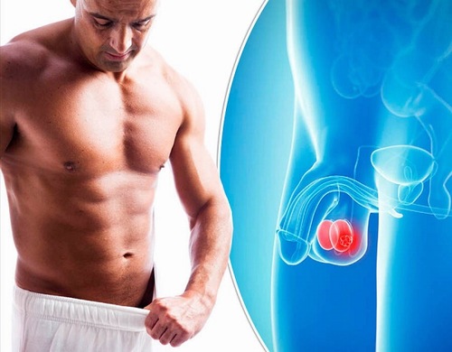 Ung thư tinh hoàn là nguyên nhân khiến tinh hoàn bị chảy xệ