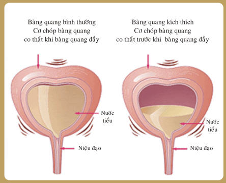 Bệnh viêm bàng quang gây ra căn bệnh viêm tinh hoàn