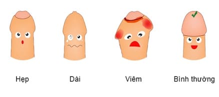 Biểu hiện viêm bao quy đầu