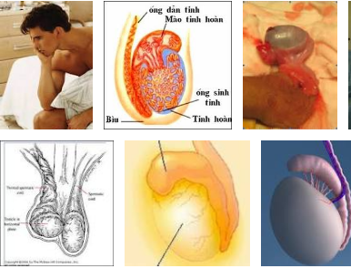 Bệnh viêm tinh hoàn do biến chứng quai bị 