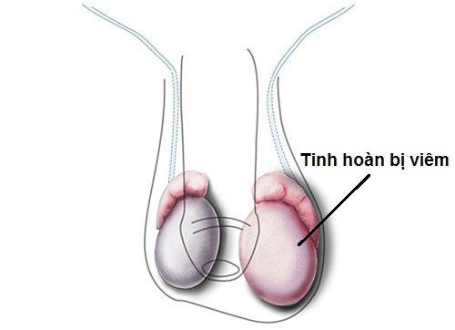 Biểu hiện tinh hoàn bị viêm