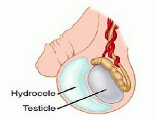 Virus quai bị gây bệnh viêm tinh hoàn